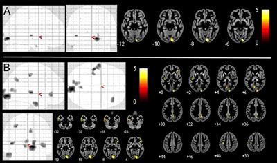 Subclinical Agoraphobia Symptoms and Regional Brain Volumes in Non-clinical Subjects: Between Compensation and Resilience?